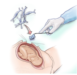 Diagram of stem cells going onto the stem cell patch, and how the patch will be applied to the fetus' spine in the mother's womb