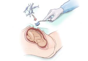 Drawing of a fetus in a womb during surgery. A patch is being applied to the fetuses back by a gloved hand.